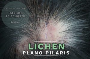 lichen-plano-pilaris